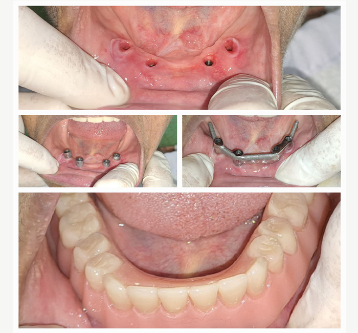 multiple-dental-implant