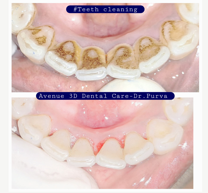 Teeth Cleaning